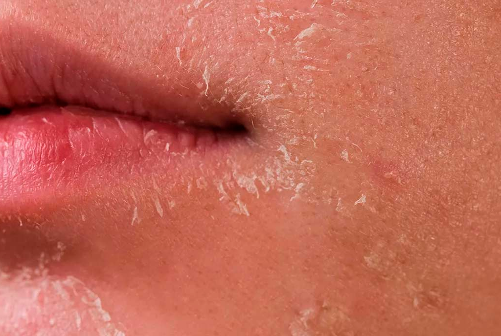 Dry Skin