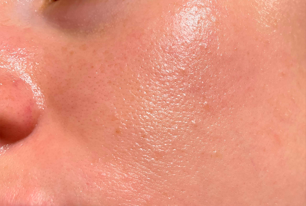 Oily Skin
