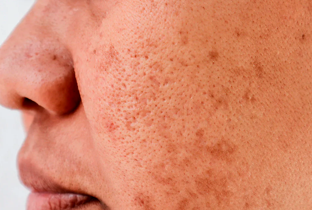 Pigmentation skin