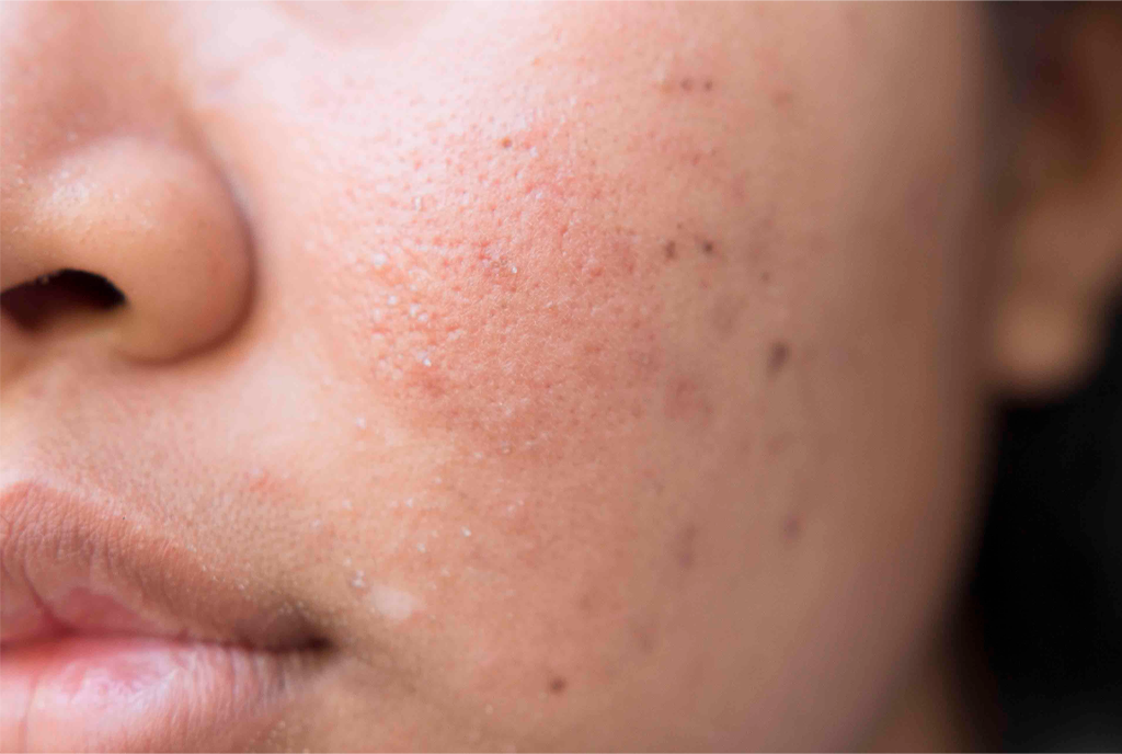 Uneven Skin tone
