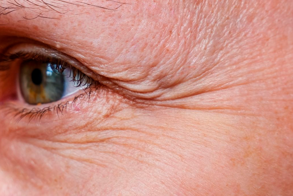 Wrinkle Skin